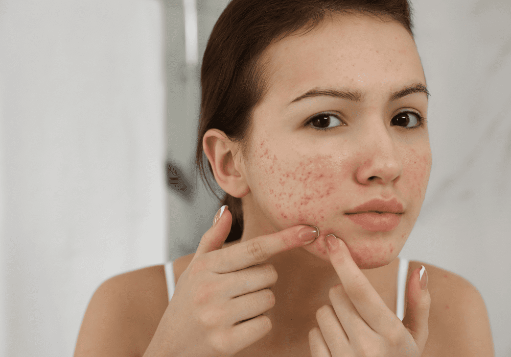 How to use Neem Leaves for Pimples and Dark Spots, Pimple Skin