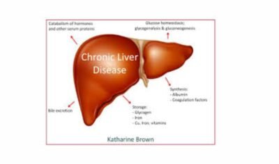 chronic liver disease icd 10,chronic icd liver 10