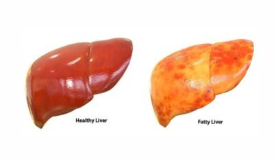 non alcoholic fatty liver disease icd 10,fatty liver disease