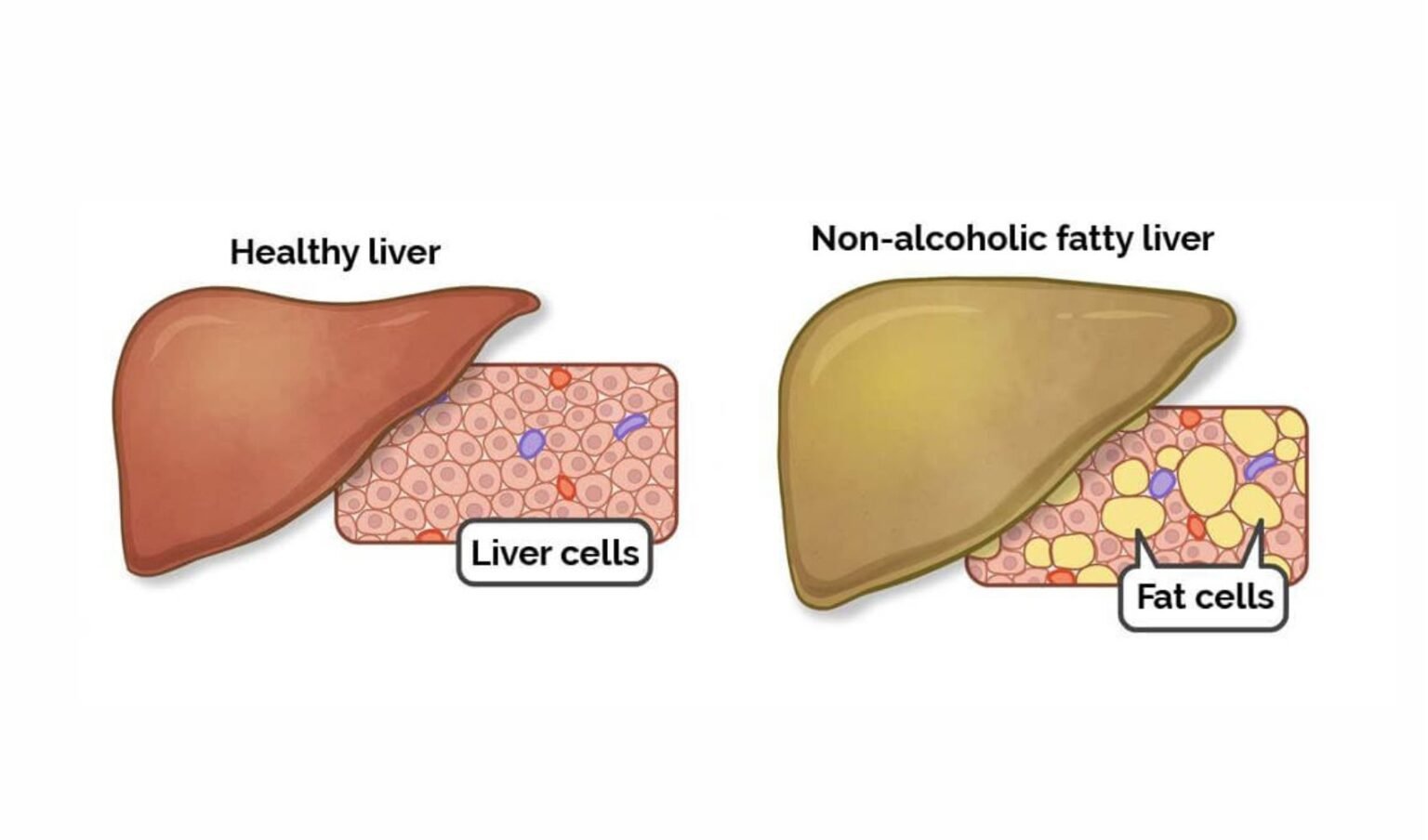 non alcoholic fatty liver cirrhosis icd 10