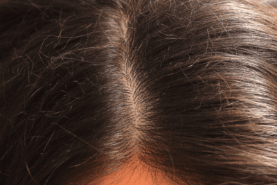 does dandruff cause hair loss, reduce hair dandruff